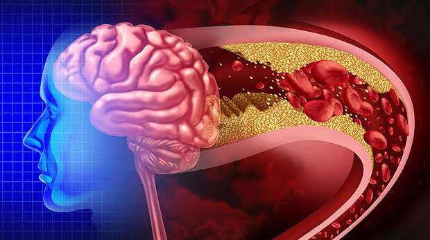 Neurology: ранние признаки проблем с сердцем связаны с уменьшением объема мозга
