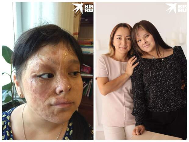 Хирурги восстанавливают лицо девочки, пострадавшей от горящей свечи