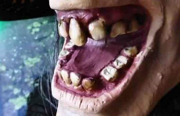 Протезы из «живых» зубов.