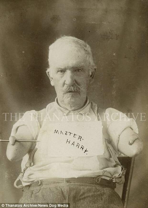 Мужчина родился с деформированными руками, 1900-е годы деформация, люди