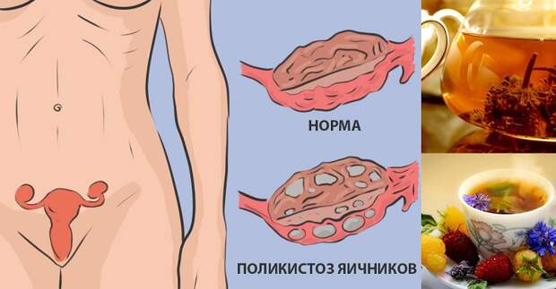 поликистоз яичников диета