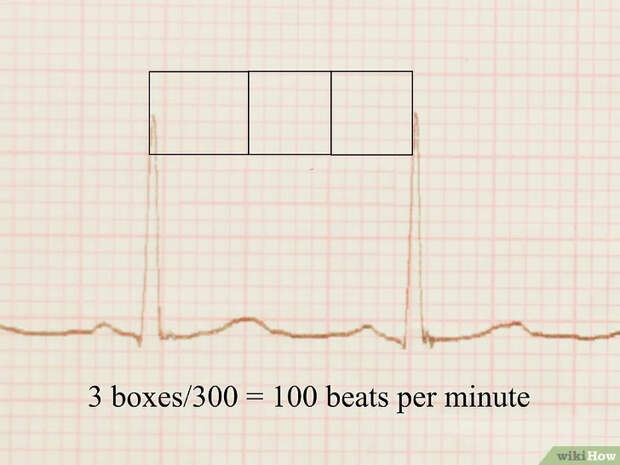 Изображение с названием Read an EKG Step 5
