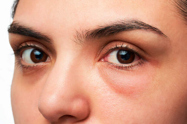 Врач Кузьмина: недосып может вызывать отеки глаз