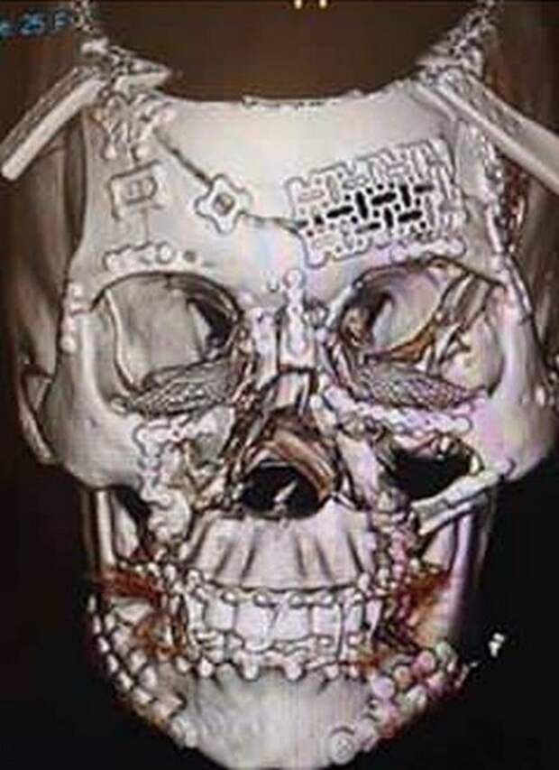 Важность ремней безопасности, рентген черепа после ДТП