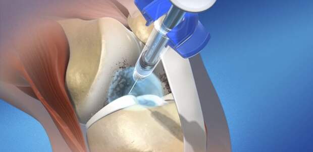 Уколы гиалуроновой кислоты в сустав: отзывы, цена, последствия