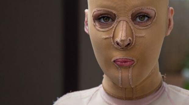 Жизнь без лица закончена: австралийка сняла маску, которую носила 2,5 года без лица, ожог