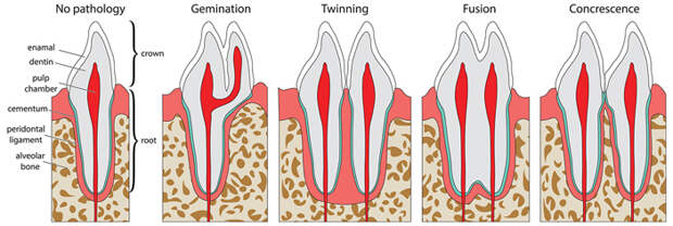 Рис. 2. Схематичное изображение известных зубных патологий на примере человеческого резца