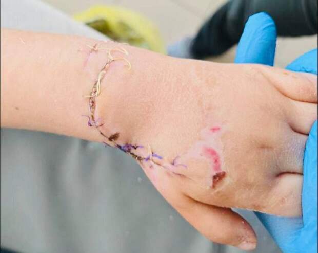 Приморские врачи восстановили руку четырёхлетней девочке