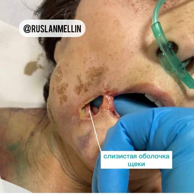 Женщина попала в больницу с двусторонней пневмонией из-за коронавируса. Однако лечиться в стационаре не захотела и написала отказ от дальнейшей терапии. Дома она также не принимала лекарства. Через несколько дней пациентка обратилась с острой болью к стоматологу, которому не сообщила о болезни. Хирург-стоматолог, не зная о наличии коронавируса и об отказе принимать антикоагулянты, предложил «импортную» анестезию, в которой содержатся вазоконстрикторы — сосудосуживающие препараты. «Сразу после удаления зуба у женщины на коже лица появился синяк, который сильно болел, кожа вокруг была бледной, а спустя несколько дней на этом месте образовался участок некроза. Наличие во рту старого протеза усугубило ситуацию, и в дальнейшем на месте некроза сформировалась так называемая оростома (дефект тканей, сообщающийся с полостью рта)», – рассказал клинический случай главный челюстно-лицевой хирург Хакасии Руслан Меллин.