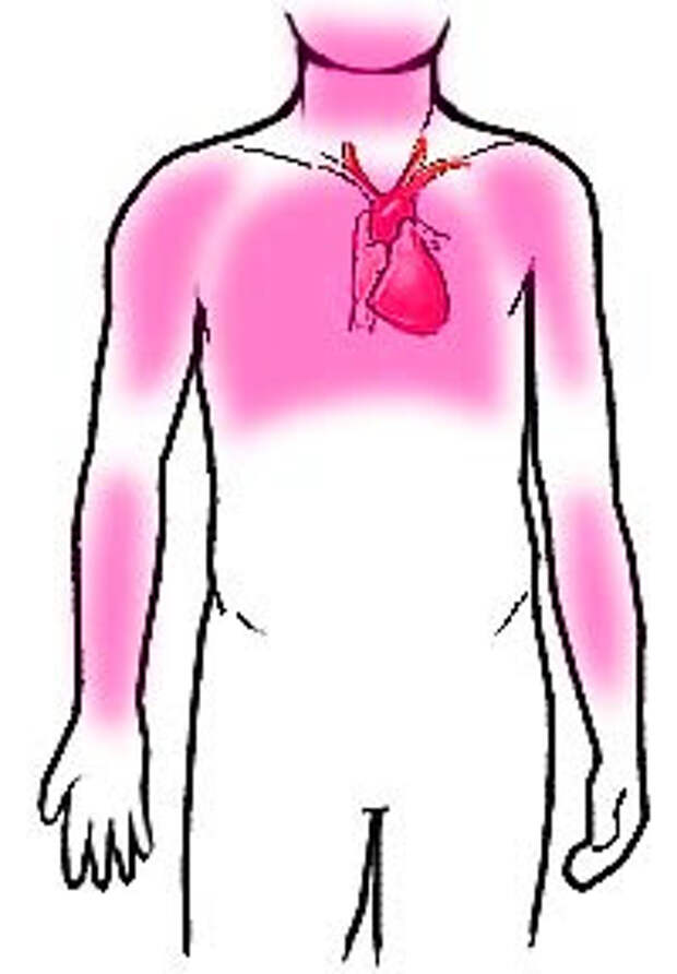 Картинки по запросу heart attack pain area