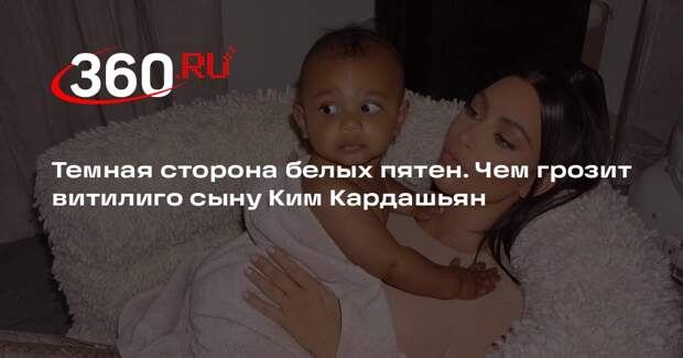 Дерматолог Скорогудаева: способа вылечить витилиго не существует