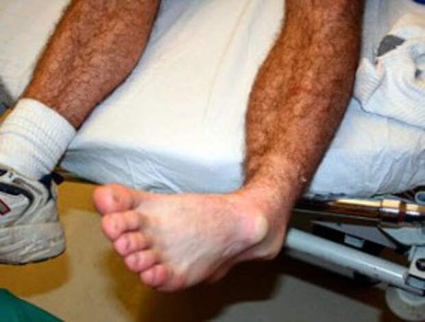 Сильно болит нога после операции. Подтаранный вывих стопы. Перелом лодыжки-гипсование. Вывих сустава голеностопа. Вывих голиностопногосустава.