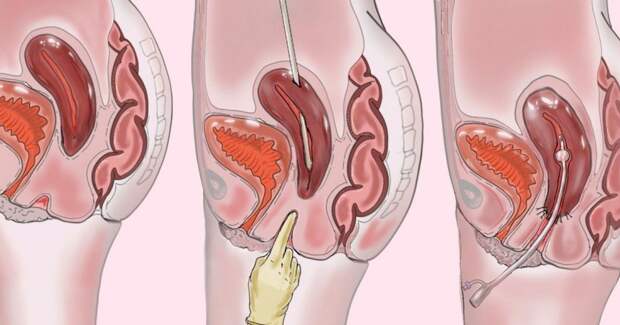 Британка, родившаяся без шейки матки и влагалища, естественно забеременела после реконструкции