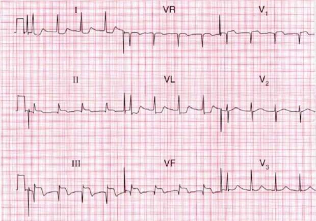 Как инфаркт миокарда диагностируется при экг?