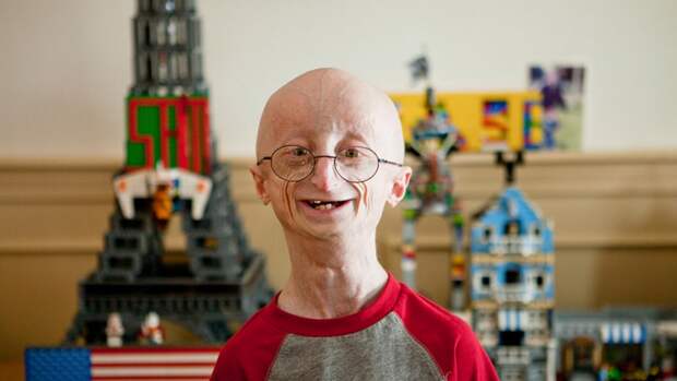 Прогерия (Progeria), синдром Гетчинсона — Гилфорда