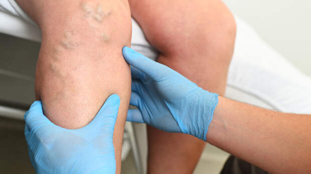 Тромбофлебит: причины, лечение и опасный вариант течения