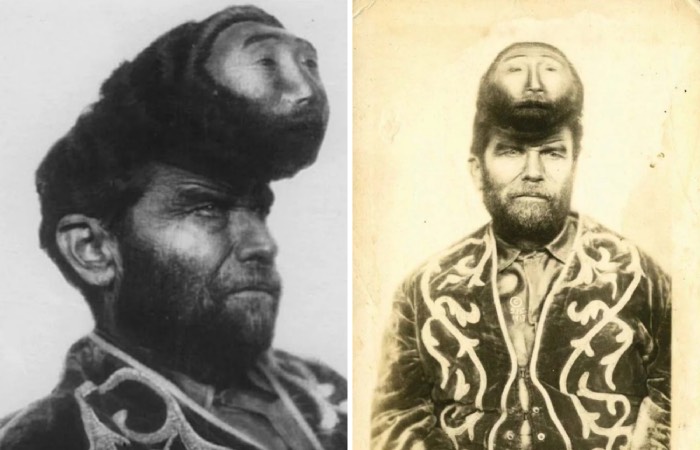 Паскаль Пинон - человек с опухолью на голове.