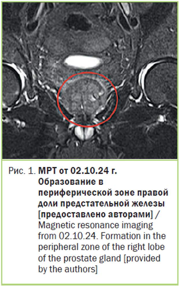 МРТ от 02.10.24 г. Образование в периферической зоне правой доли предстательной железы