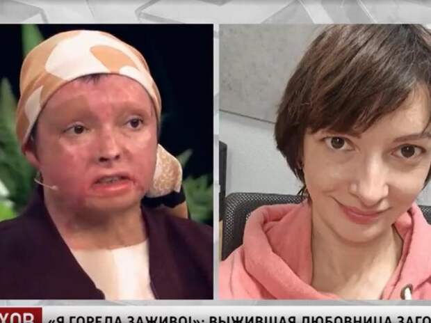 Инна Цыбасова, которую подожгла жена любовника, пришла на ТВ: у нее 85% ожогов