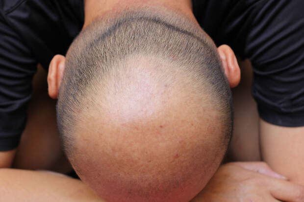 ПНИПУ: новая программа взвешивает риски и прогнозирует алопецию