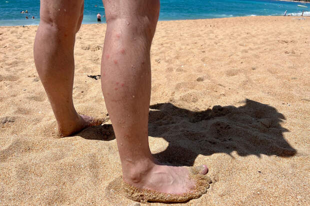 В Таиланде не смогли спасти пожилого мужчину после укуса мошек в ногу