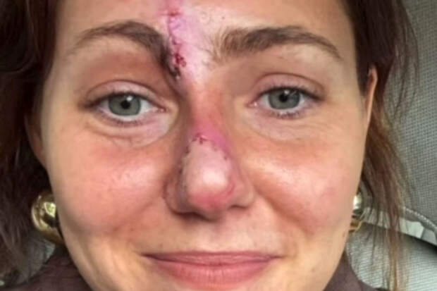 The Sun: британка перенесла пластику после того, как собака откусила ей нос