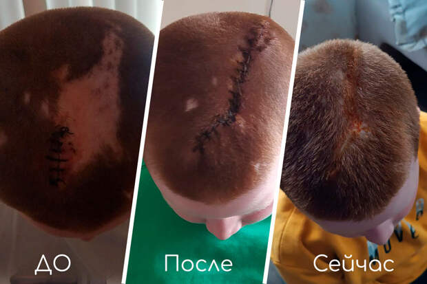 В Челябинске врачи восстановили волосы мальчику, получившему страшные ожоги