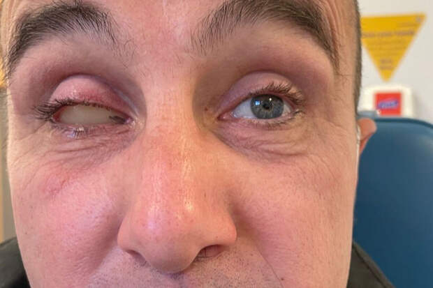 Британец лишился глаза из-за царапины, полученной во время игры в волейбол