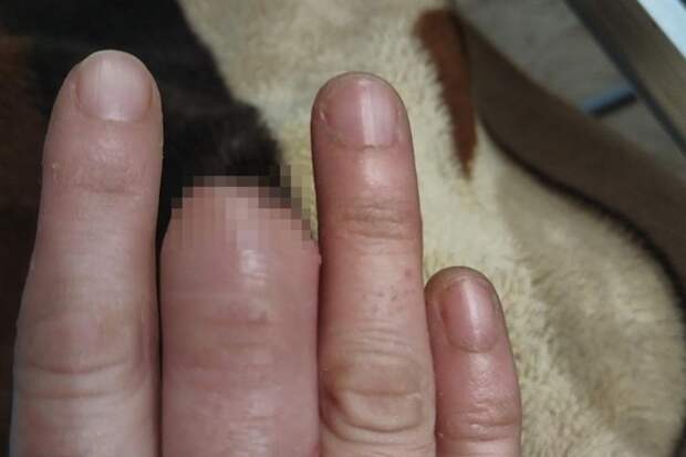 Хирург помазал женщине отрезанный палец мазью и отправил домой