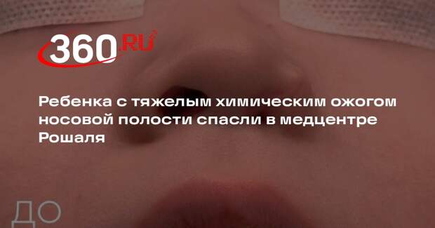 Ребенка с тяжелым химическим ожогом носовой полости спасли в медцентре Рошаля