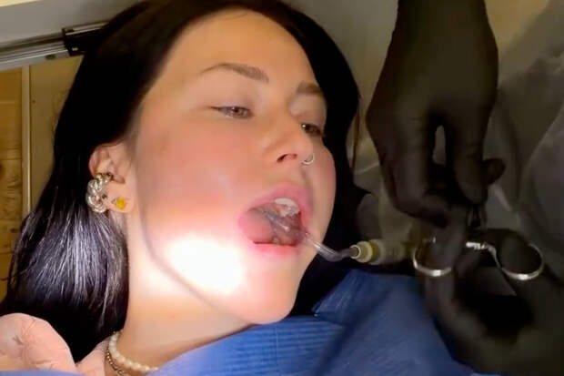 Россиянка осталась с зашитой щекой и гематомой после стоматолога