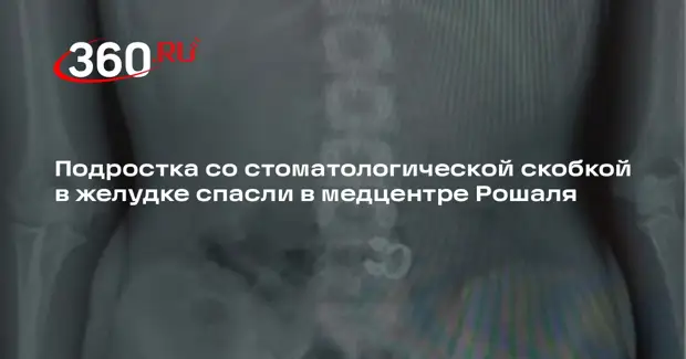 Подростка со стоматологической скобкой в желудке спасли в медцентре Рошаля
