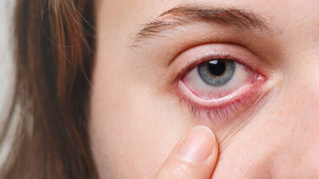 Покраснение глаз: почему бывает и что делать