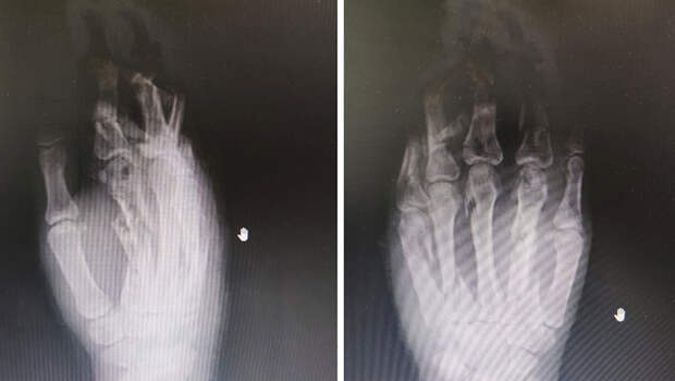 Сделали невозможное: российские врачи спасли кисть девушки, раздробленную в мясорубке