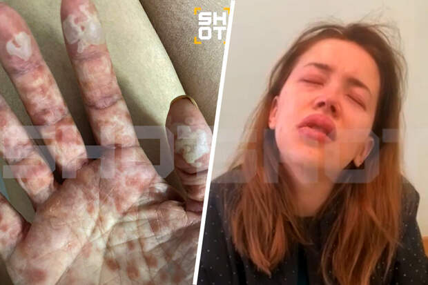 Таблетки от мигрени вызвали опасный для жизни синдром у жительницы Балашихи