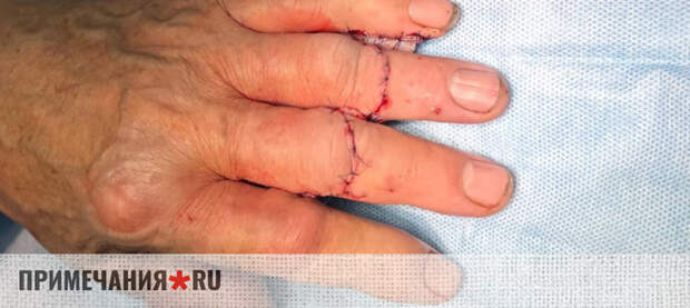 Девять часов на спасение: хирургам удалось восстановить пальцы пациента, которые отрезало болгаркой