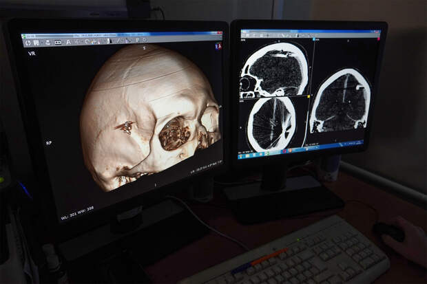 Россиянин сутки проходил с пулей в мозге