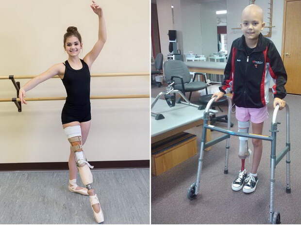 Балерина без ноги: 15 летняя девушка победила рак на пути к своей мечте