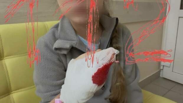 Девочке грозит ампутация пальца из-за травмы в бийском детсаду