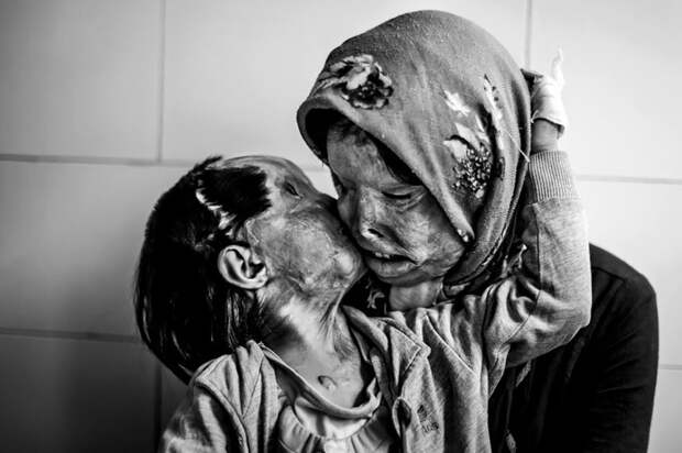 3-летняя Рана целует свою 29-летнюю мать Сомайе Мери. По их словам, после того как им в лицо плеснули кислотой, другие люди не горят желанием целовать их. история, факты