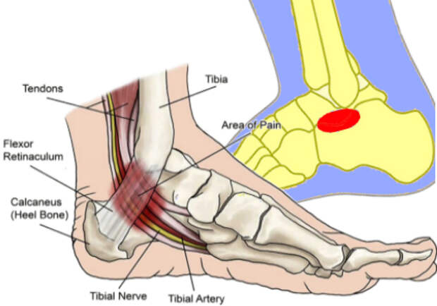 Синдром синуса стопы (синонимы: синдром пазухи предплюсны, синдром тарзального канала)
