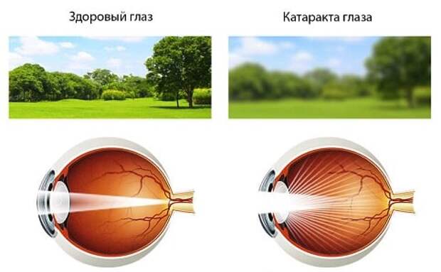 Лечение катаракты - показания и виды операции (2)