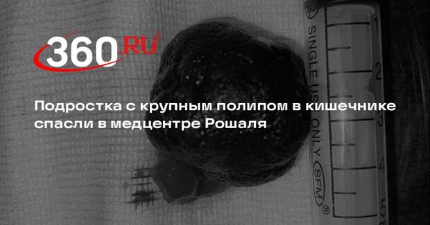 Подростка с крупным полипом в кишечнике спасли в медцентре Рошаля