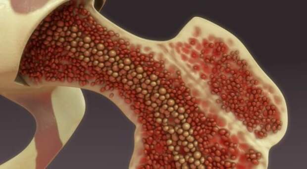 Пересадка костного мозга. Костный мозг — орган, который вырабатывает кровь человека. Источник: pcr.news. Фото.