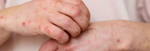 Какие меры ввели в Казахстане из-за роста заболеваемости корью