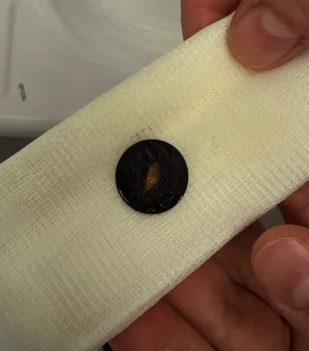 Әлмәттә табиблар акча йоткан баланы коткарган