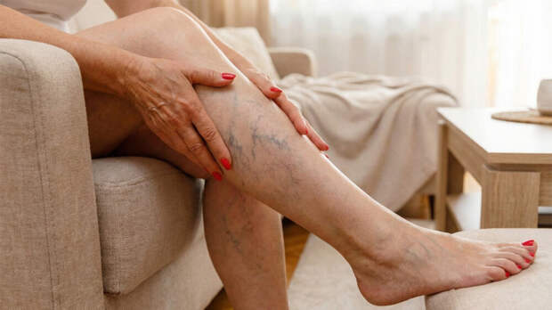 Варикоз после 50 лет — норма или угроза жизни