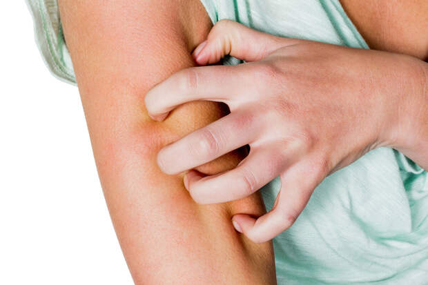 The Conversation: в Великобритании произошел резкий рост заболеваемости чесоткой