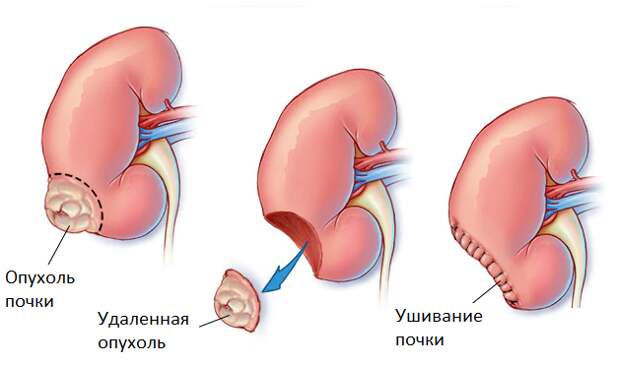 Лапароскопическая резекция – простое и надежное лечение рака почки