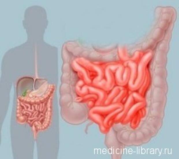лечение колита кишечника